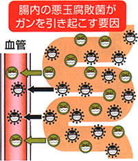 腸内の悪玉腐敗菌がガンを引き起こす要因